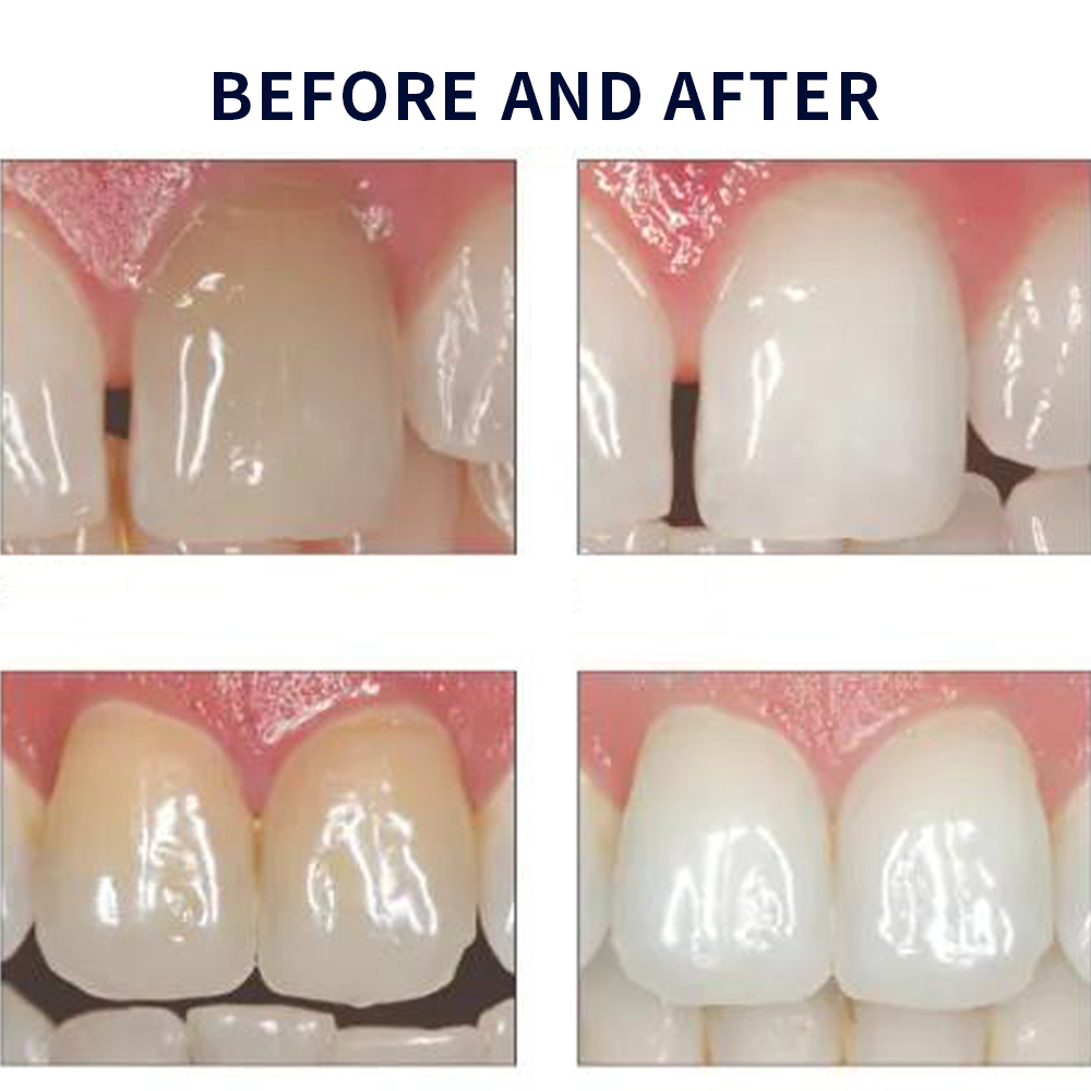 Opalescence Whitening 20% PF 2 - Teeth Whitening Hydrogen Peroxide recension och pris