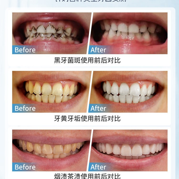 Japan Manual Tooth Stain Remov - Teeth Whitening In Japan recension och pris