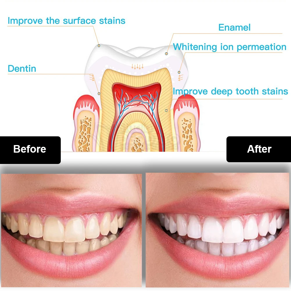 Dental Teeth Whitening Kit Min - Teeth Whitening Kit With Light recension och pris
